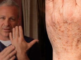 Американский доктор рекомендует: простой трюк быстро устранит пигментные пятна на коже!